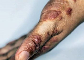 Segundo lugar en casos de escabiosis en el país