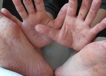 Coxsackie aumenta presencia en temporada de calor y lluvias